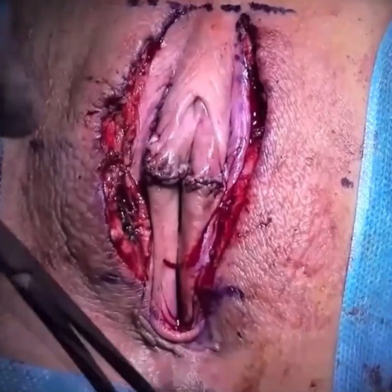 Labiamajoraplasty in office