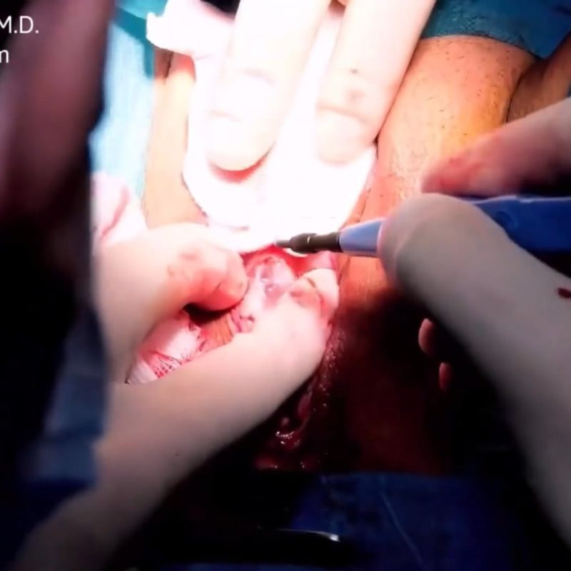 Rotation flap  180 degree after labia minora amputating labiaplasty.Reconstruction vulvar surgery.