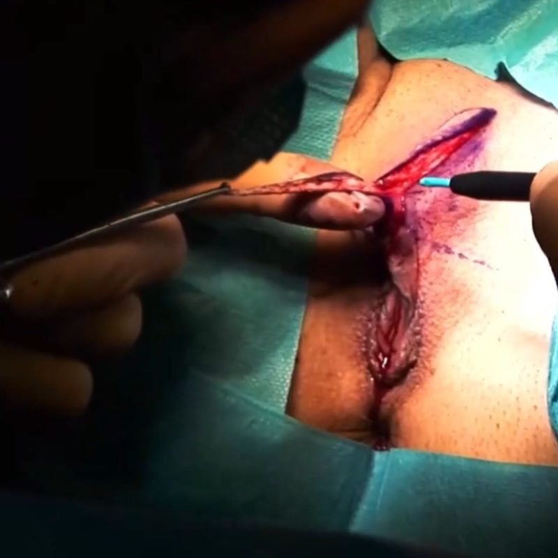 Hoodoplasty / clitoral prepuce surgical reduction