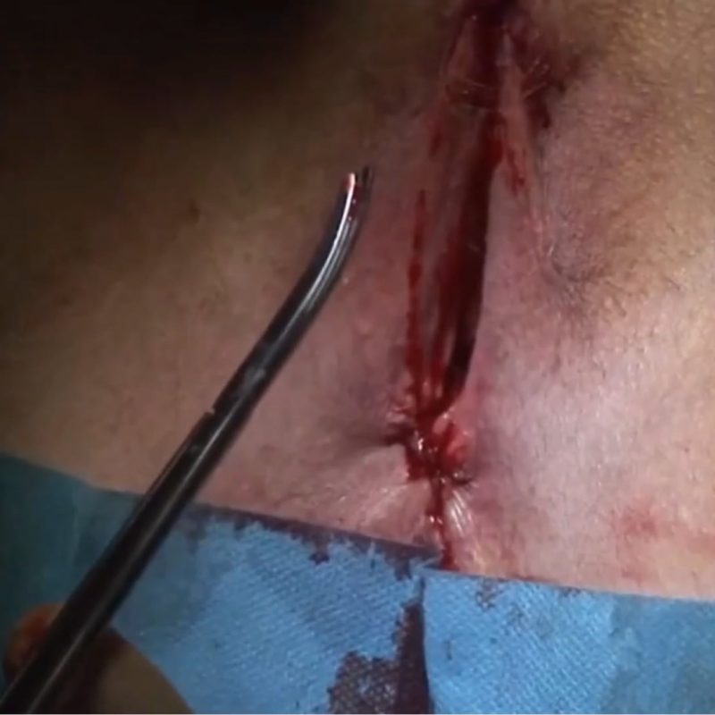 Extreme adhesion in the course of vulvar lichen sclerosus. Clitoral release and recreation od a new clitoral glans. Regenerative