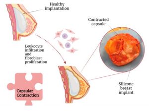 Czy implanty piersi są bezpieczne? Choroba implantów piersi – Breast Implant Illness (BII) – objawy ogólnoustrojowe związane z implantami piersi. Co mówi współczesna medycyna?
